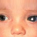 Sinar putih di mata bayi petunjuk kanker