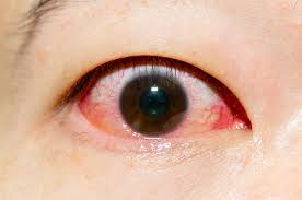 Diabetes Dan Hipertensi Bisa Berakibat Pada Pembuluh Mata
